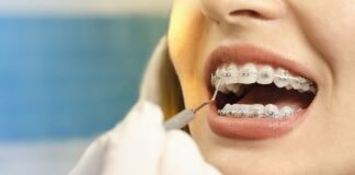 Встановлення брекетів – шлях до рівної та здорової усмішки